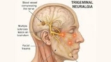 A Patient Journey for Living a Normal Life with Trigeminal Neuralgia – Best Trigeminal Neuralgia Specialist Kolkata, India