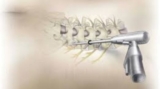 Spine Surgery in India: Quick Recovery in Minimally Invasive Spine Surgery