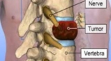 Spine Tumor Surgery in Kolkata Contact the Best Spine Neurosurgeon in India
